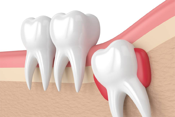 Wisdom Tooth Extraction